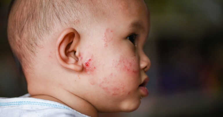 Read more about the article How To Get Rid Of My Baby’s Eczema? 7 Easy Tips To Try Now