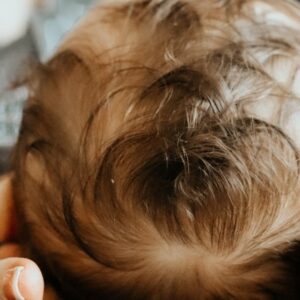 Baby Cradle Cap: Symptoms, Causes, Treatments, FAQ