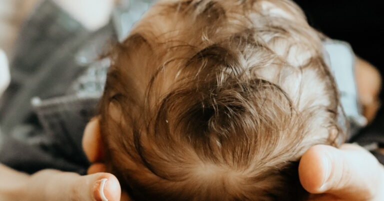 Read more about the article Baby Cradle Cap: Symptoms, Causes, Treatments, FAQ