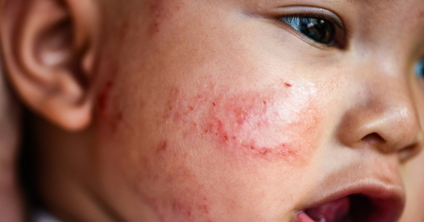 baby with eczema on the face