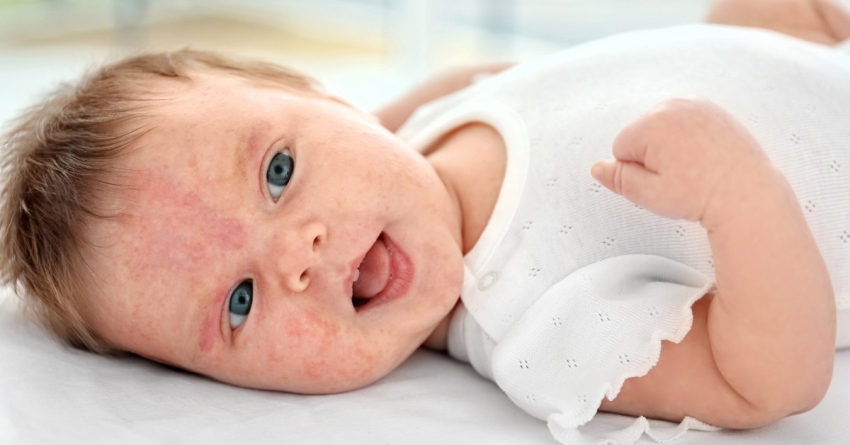 eczema in children and babies